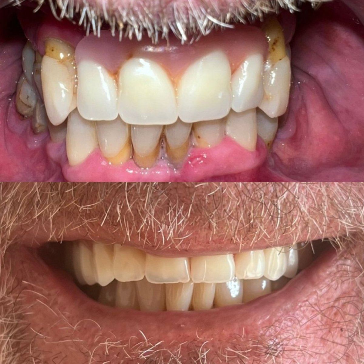 Résultats avant et après implant dentaire à Clínica Dental Raíces, sourire amélioré
