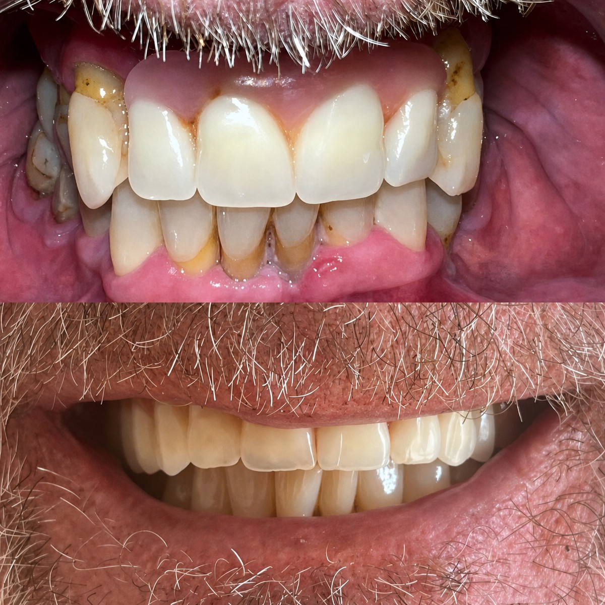 Résultat avant-après implants All-on-4 à Clínica Dental Raíces, sourire amélioré