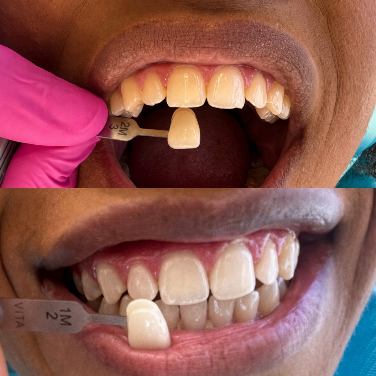 Résultats avant et après blanchiment des dents à Clínica Dental Raíces, sourire plus éclatant