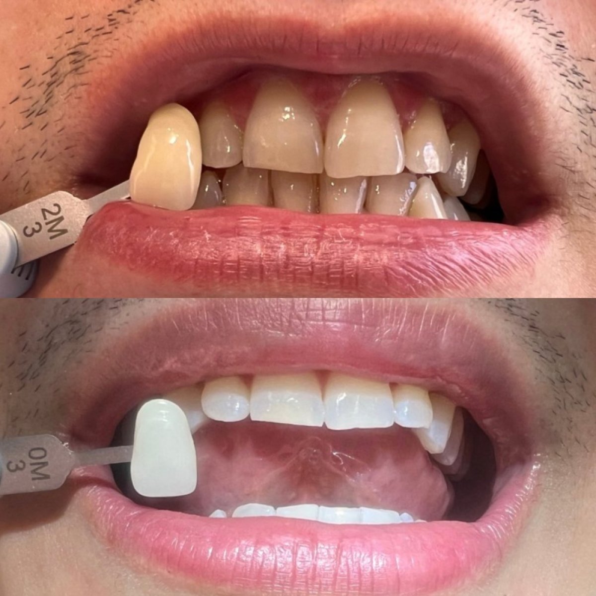 Before and after tooth whitening results at Clínica Dental Raíces, visibly brighter smile