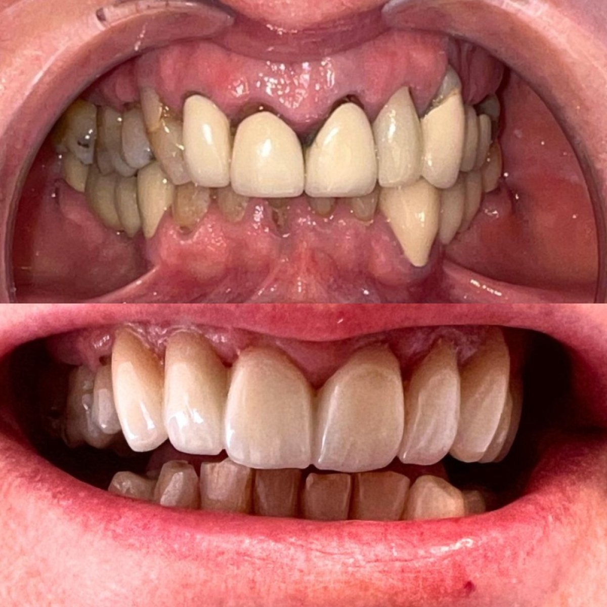 Vorher-nachher-Ergebnis Zahnkronen bei Clínica Dental Raíces, verbesserte Zahnästhetik
