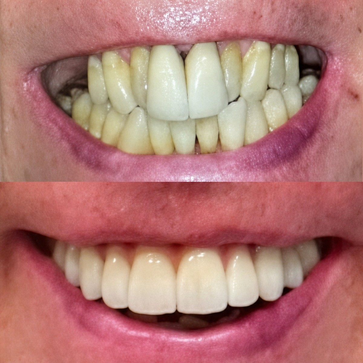Résultat avant-après implants All-on-6 à Clínica Dental Raíces, sourire amélioré