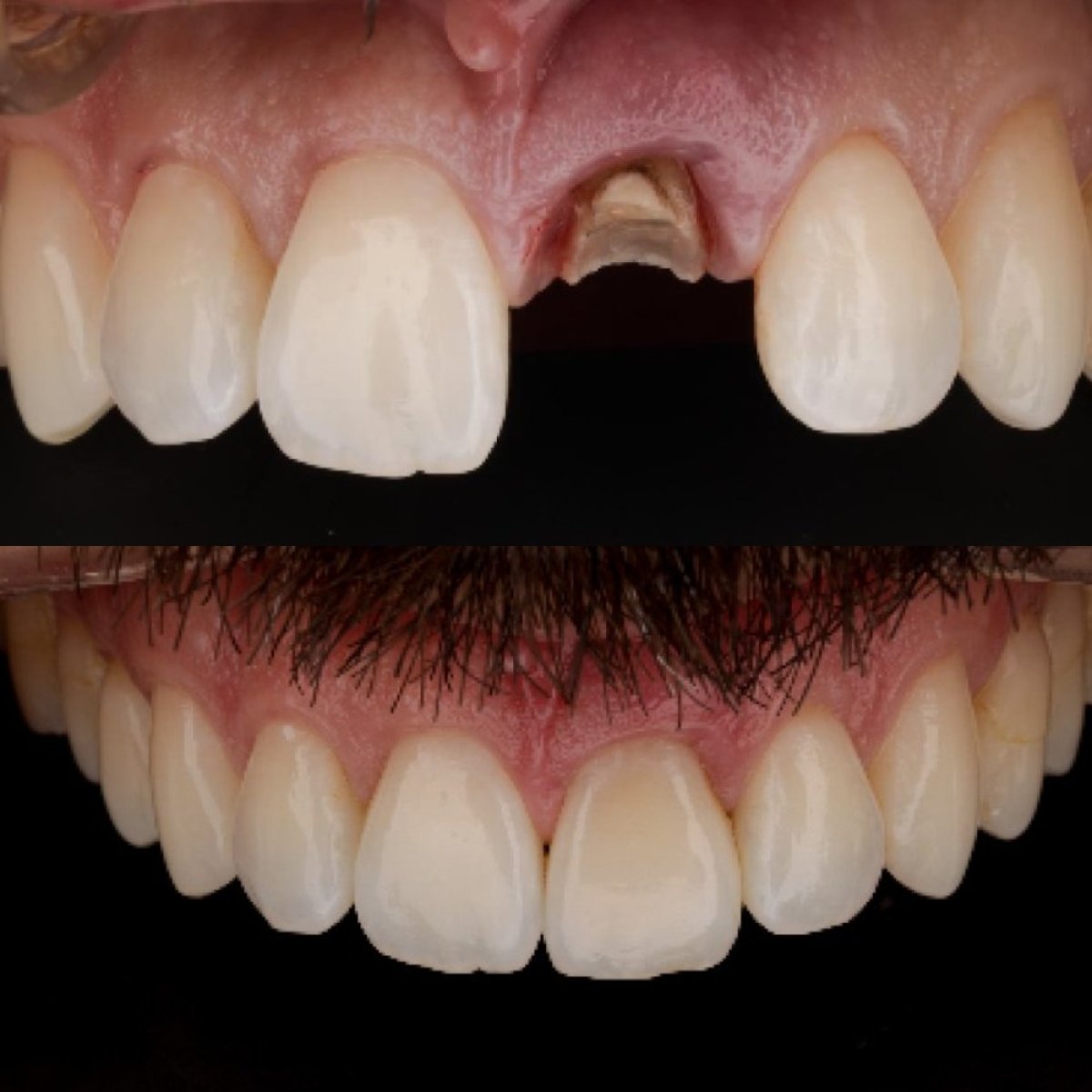 Resultados de implante dental antes y después en Clínica Zago, restauración de dientes frontales