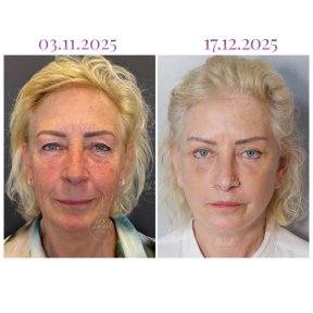 Upper & Lower Blepharoplasty - All Included - photo 6