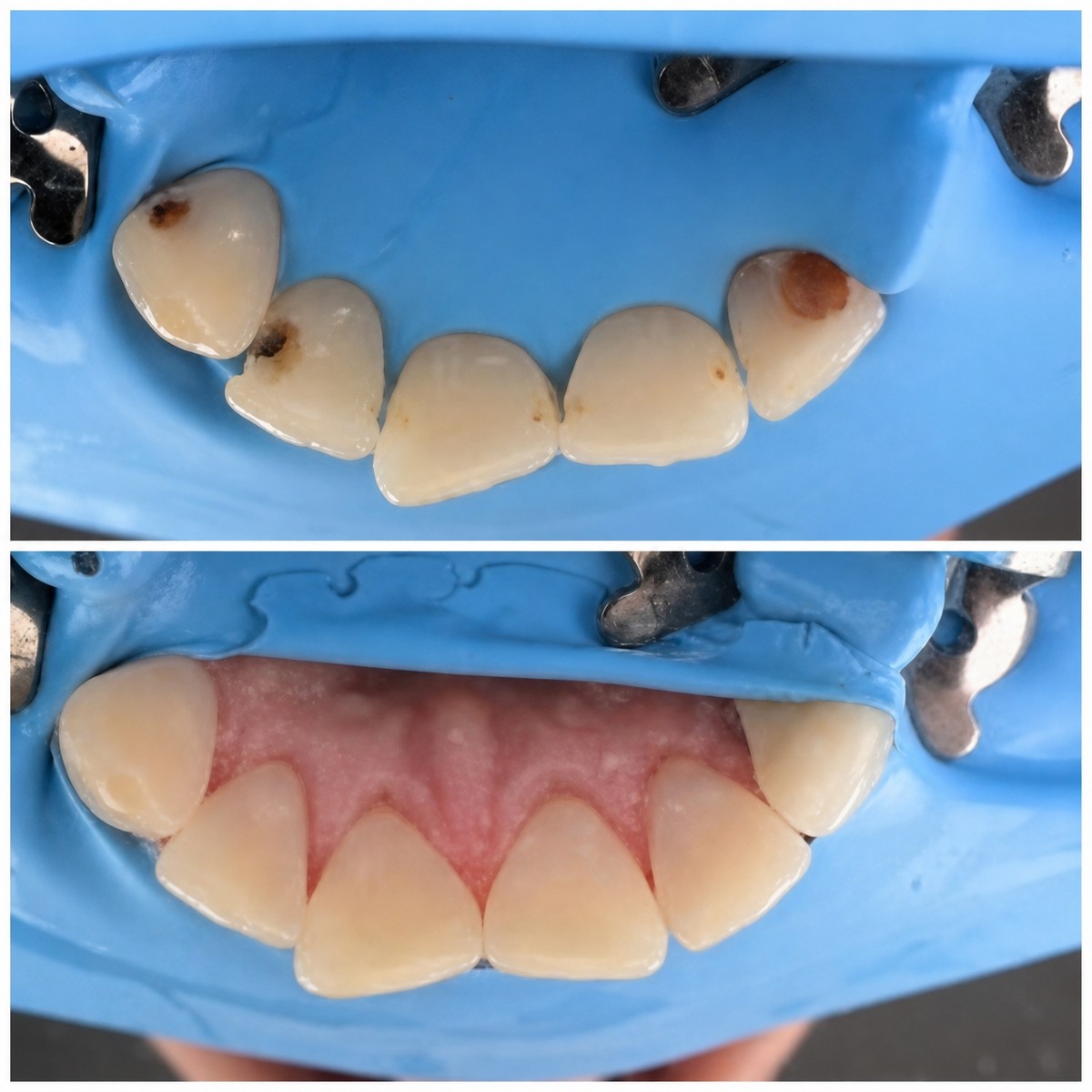 Resultados antes y después de relleno estético en RIKOTA Dental Clinic, dientes restaurados