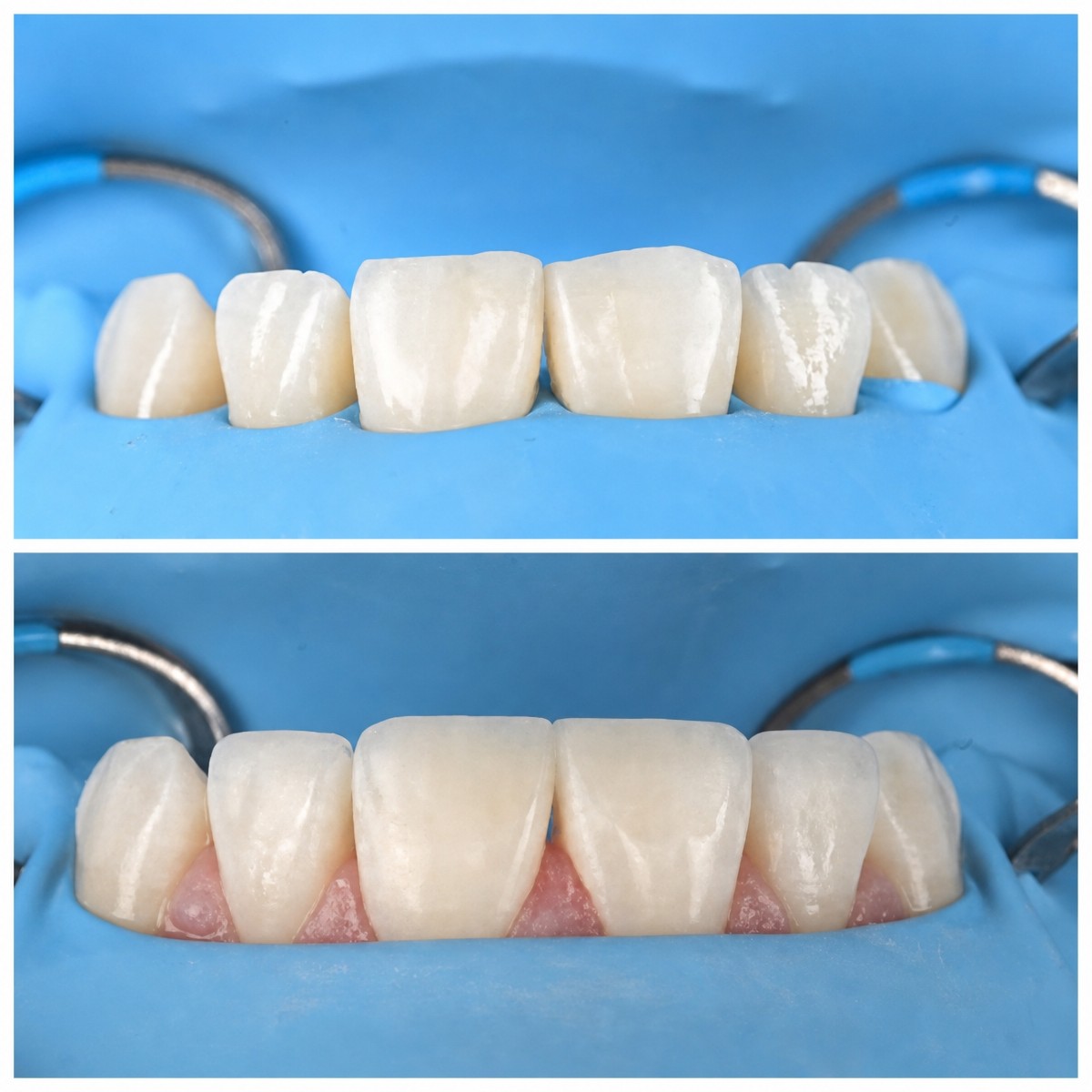 Before and after aesthetic composite filling results at RIKOTA Dental Clinic, improved smile