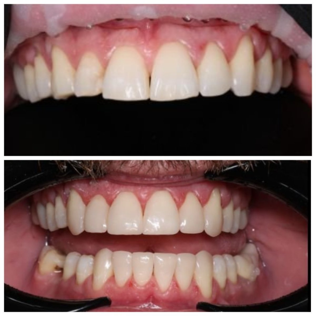 Resultados antes y después de relleno estético compuesto en RIKOTA Dental Clinic, sonrisa mejorada