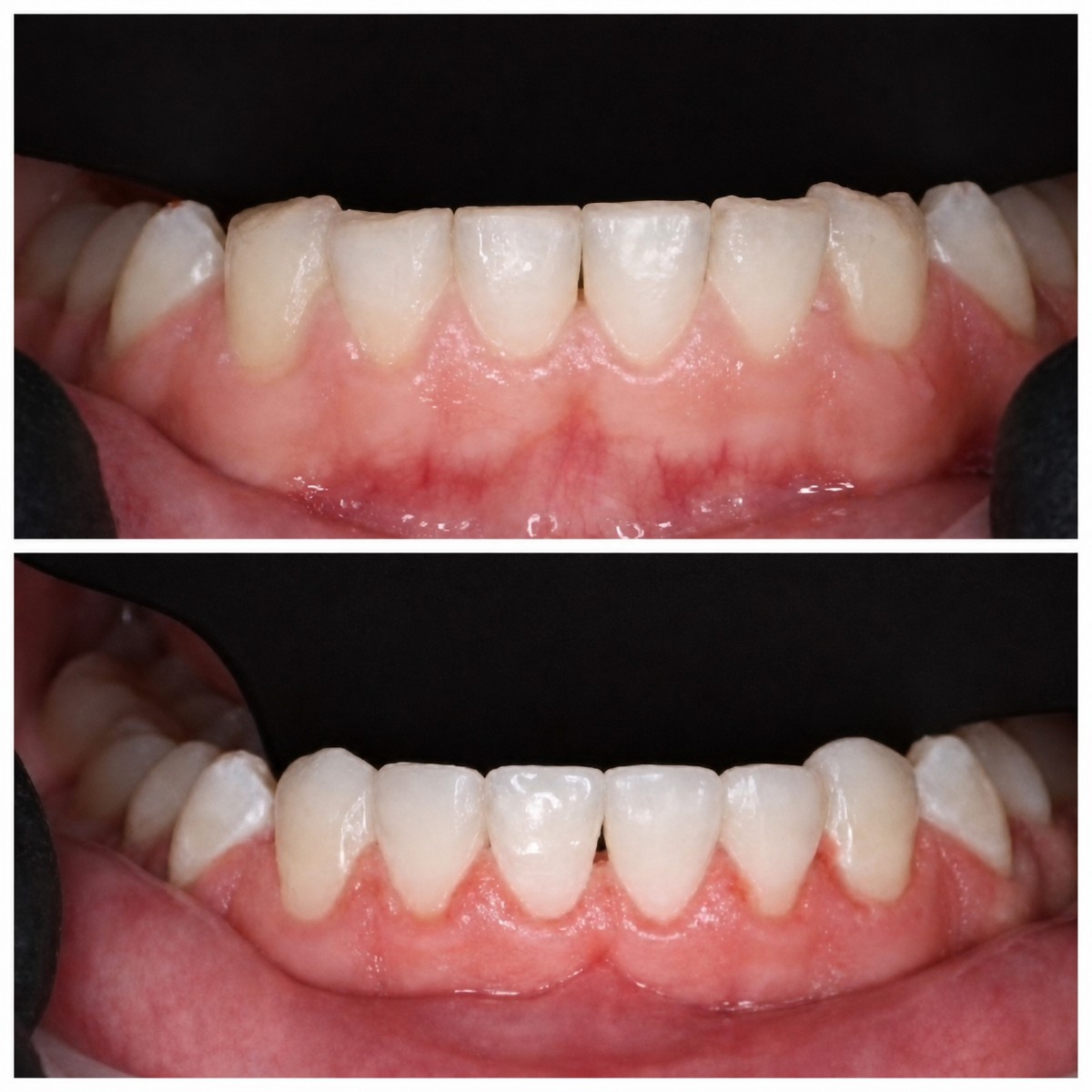 Resultados antes y después de relleno estético en RIKOTA Dental Clinic, sonrisa mejorada
