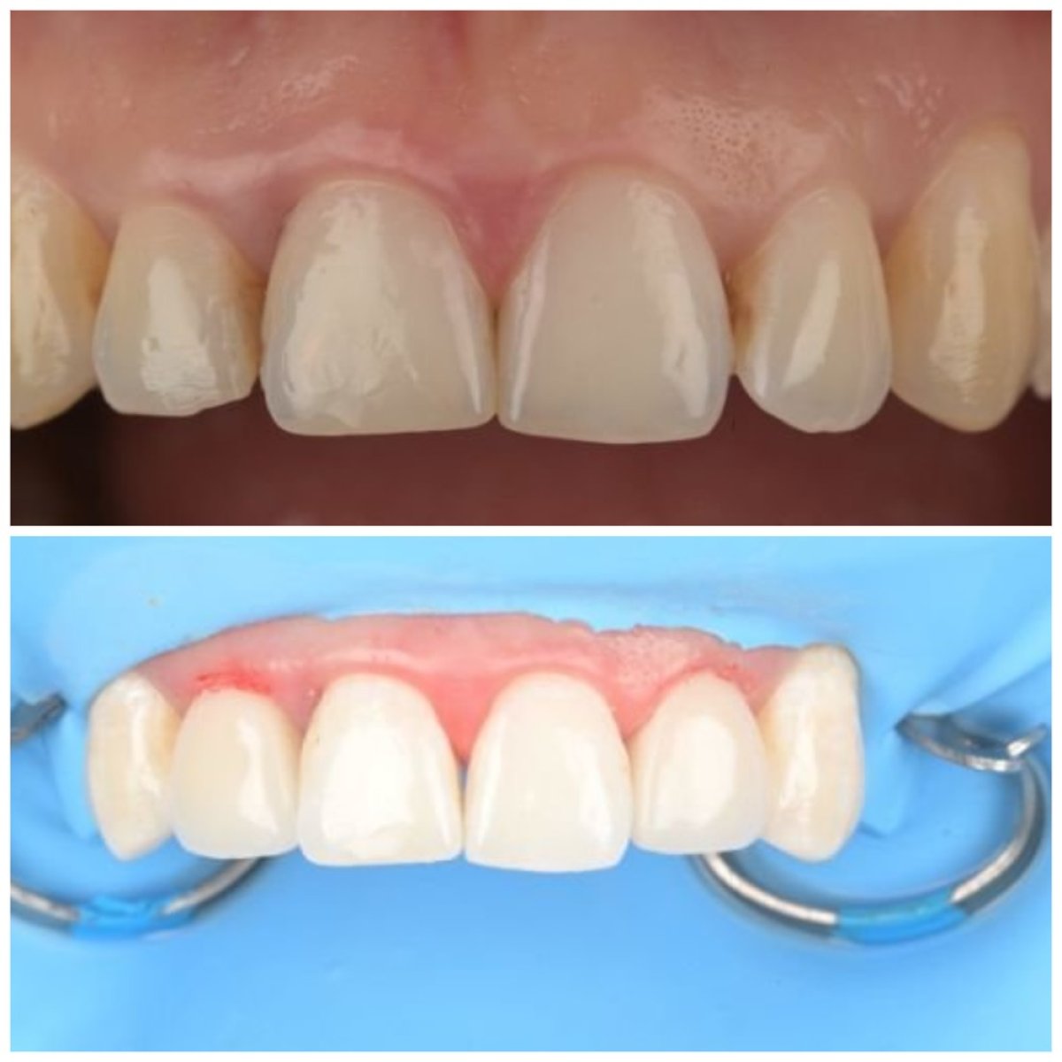 Resultados antes y después de relleno estético en RIKOTA Dental Clinic, sonrisa mejorada