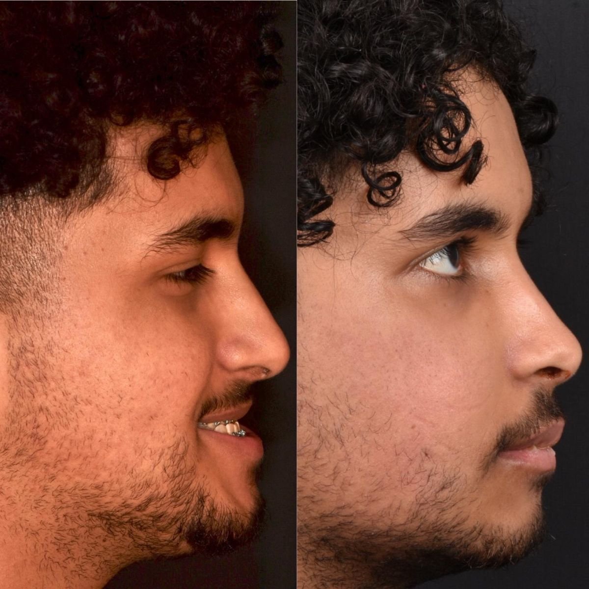 Résultats avant et après implant de mâchoire à Dentavie Istanbul Dental Clinic, contour amélioré