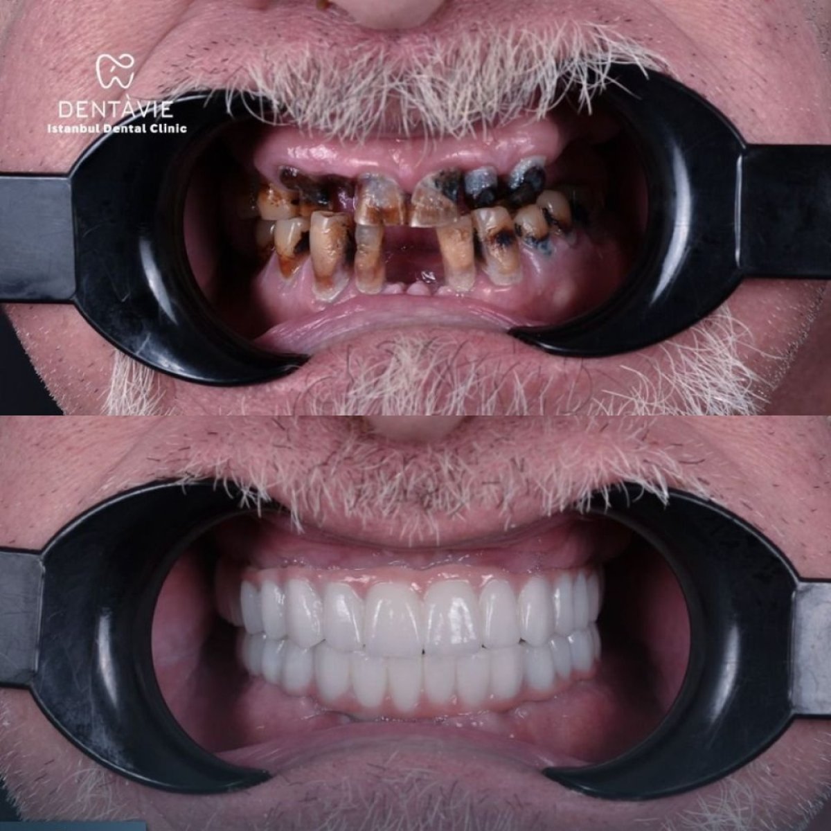 Результаты до и после имплантации зубов в Dentavie Istanbul Dental Clinic, полное восстановление улыбки