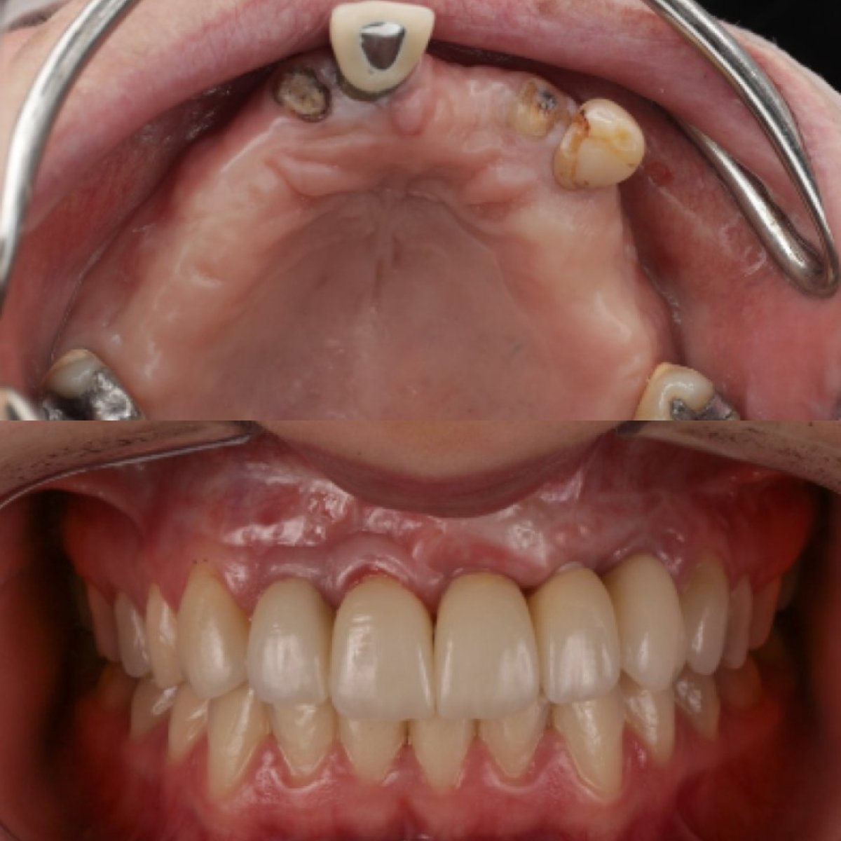 Resultados antes y después de implantes dentales en Clínica Zago: restauración dental superior