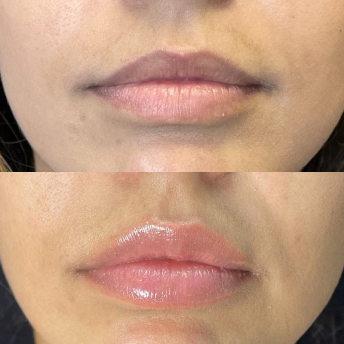 Antes y después de relleno de labios en Clínica Zago, mayor volumen y contorno labial