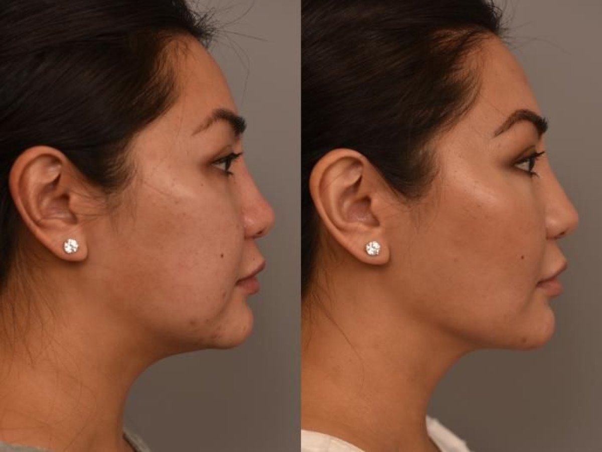 Результаты до и после имплантации подбородка в Dr. Alexandro Aguilera - Plastic Surgery, улучшенный профиль