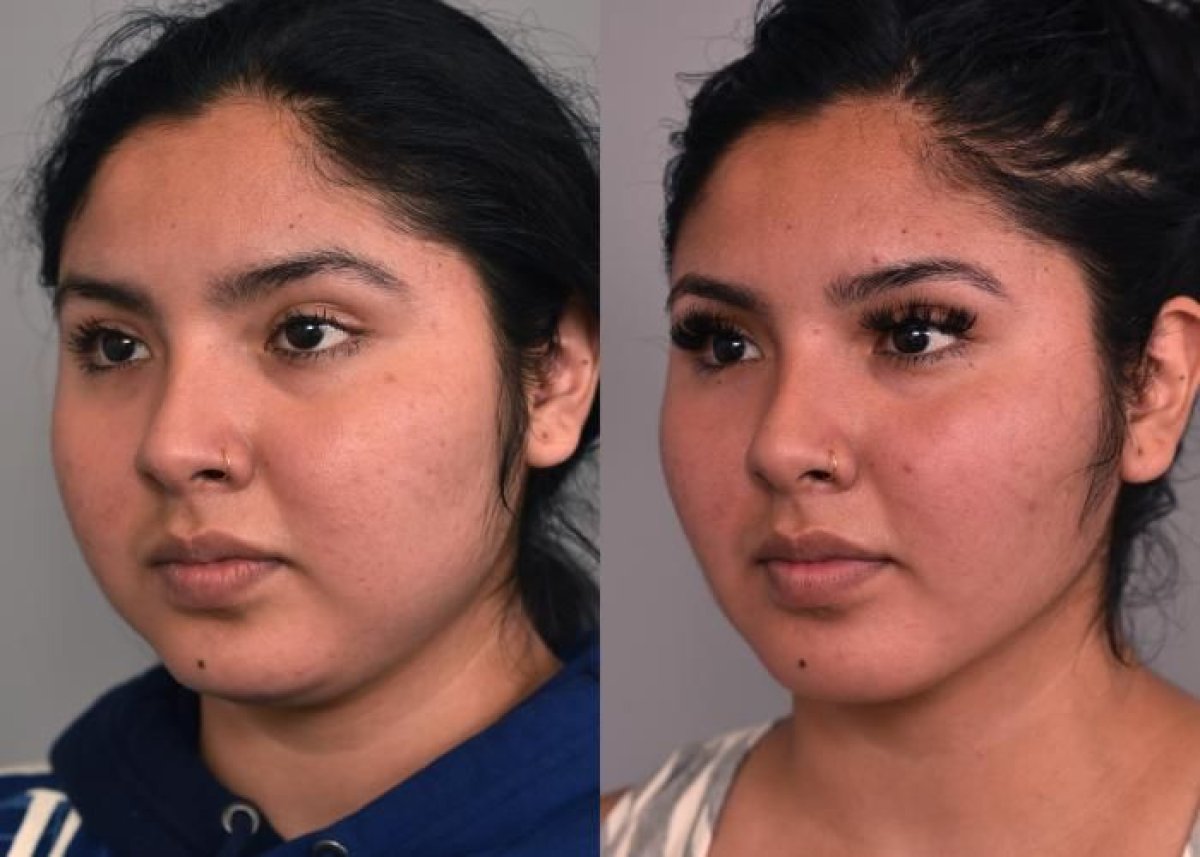 Resultados antes y después de implante de mentón en Dr. Alexandro Aguilera - Plastic Surgery