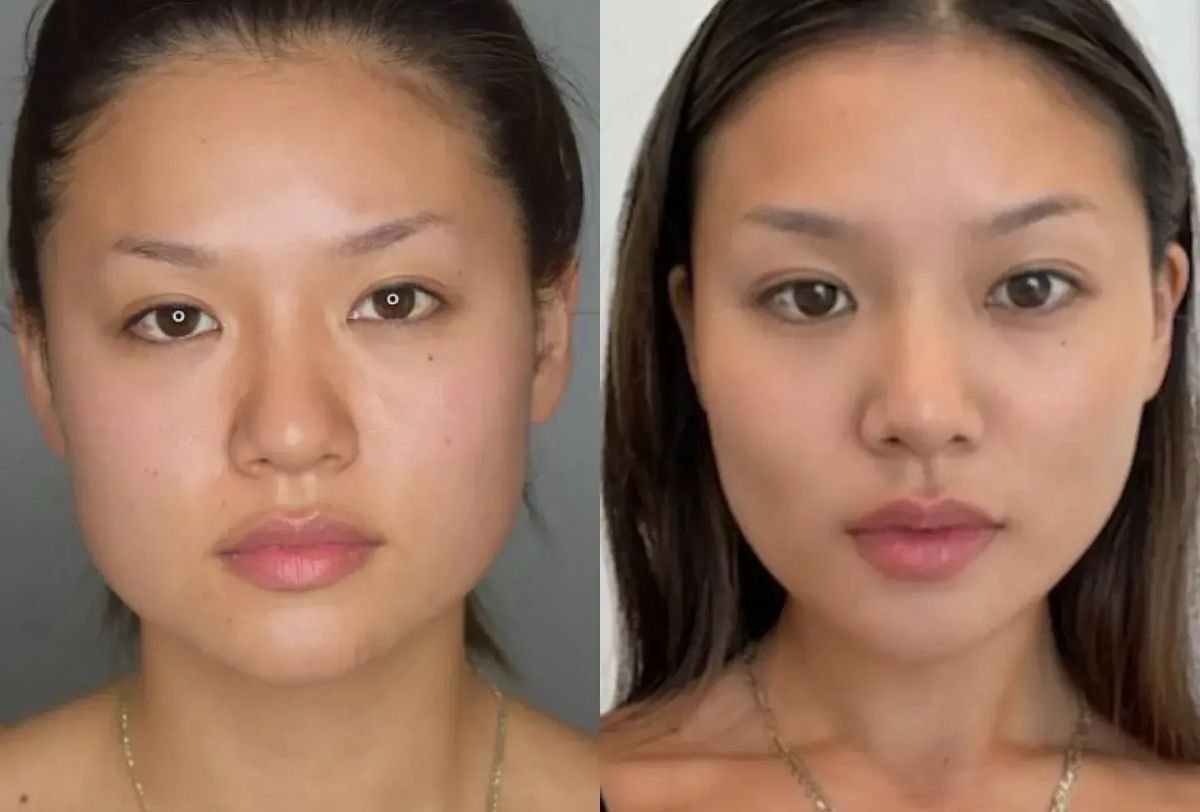 Resultados antes y después de implante de mentón en Dr. Alexandro Aguilera - contorno facial