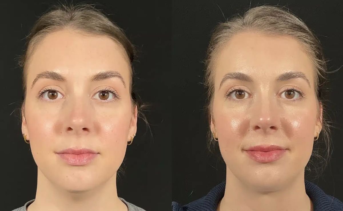 نتائج قبل وبعد زراعة الذقن في Dr. Alexandro Aguilera - Plastic Surgery، تحديد الوجه