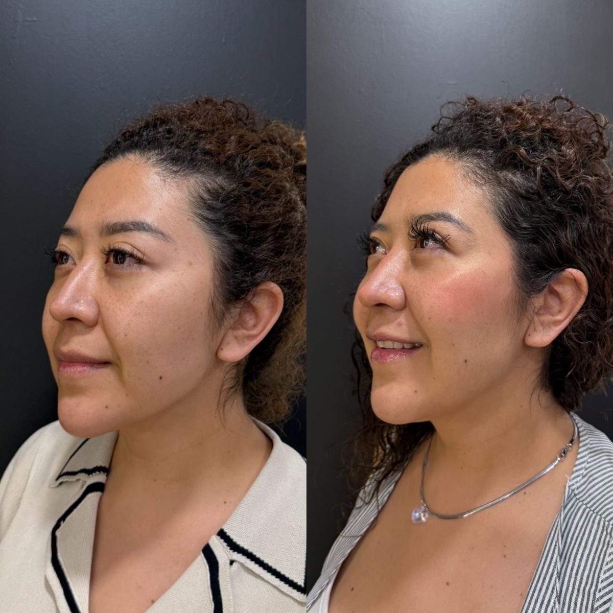 Before and after facial fat transfer results at Dr. Alexandro Aguilera - Plastic Surgery clinic