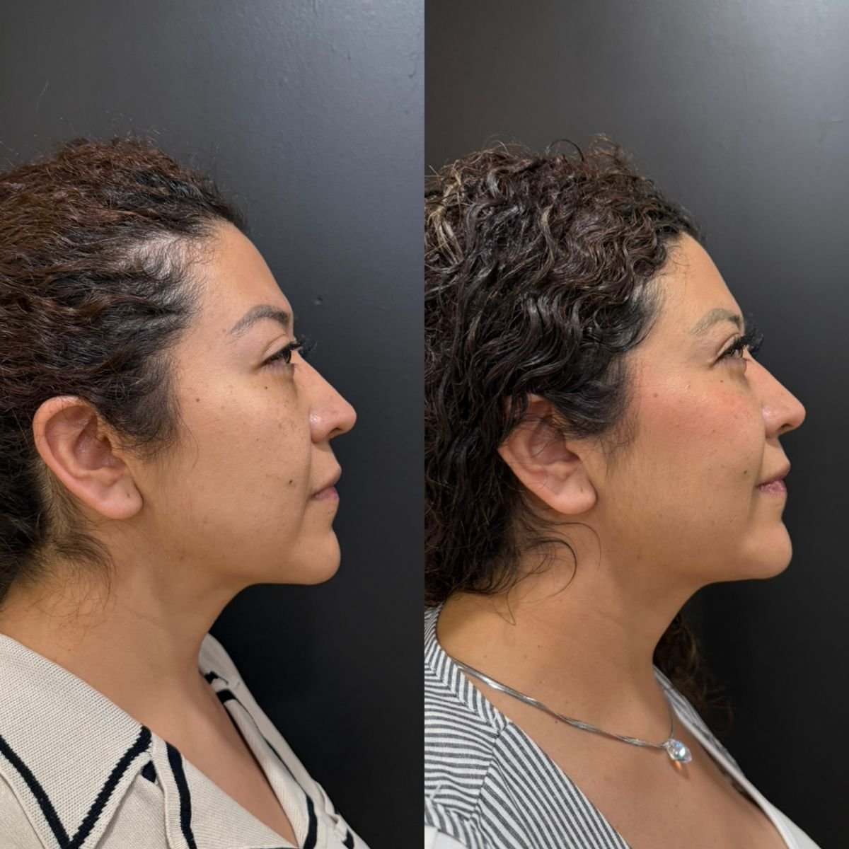 Before and after facial fat transfer result at Dr. Alexandro Aguilera - Plastic Surgery clinic