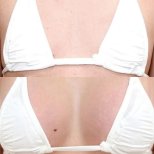 Before and after Breast augmentation photos by Dr. 
