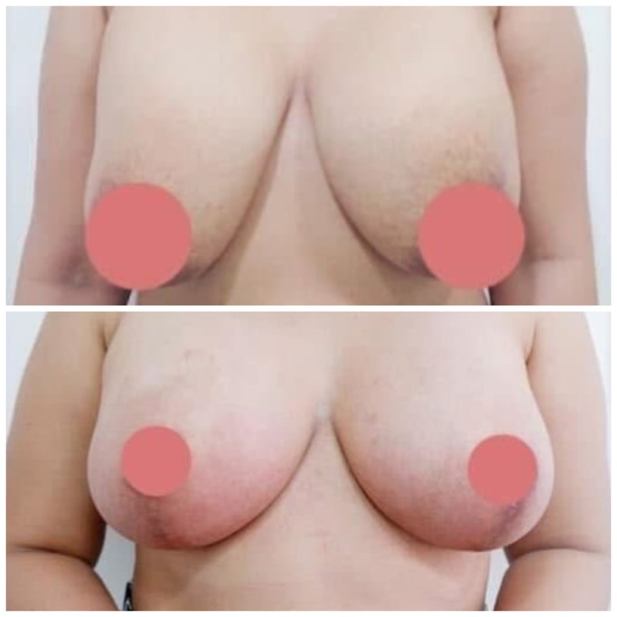 Before and after breast lift results at Somchai Clinic, improved breast contour and firmness