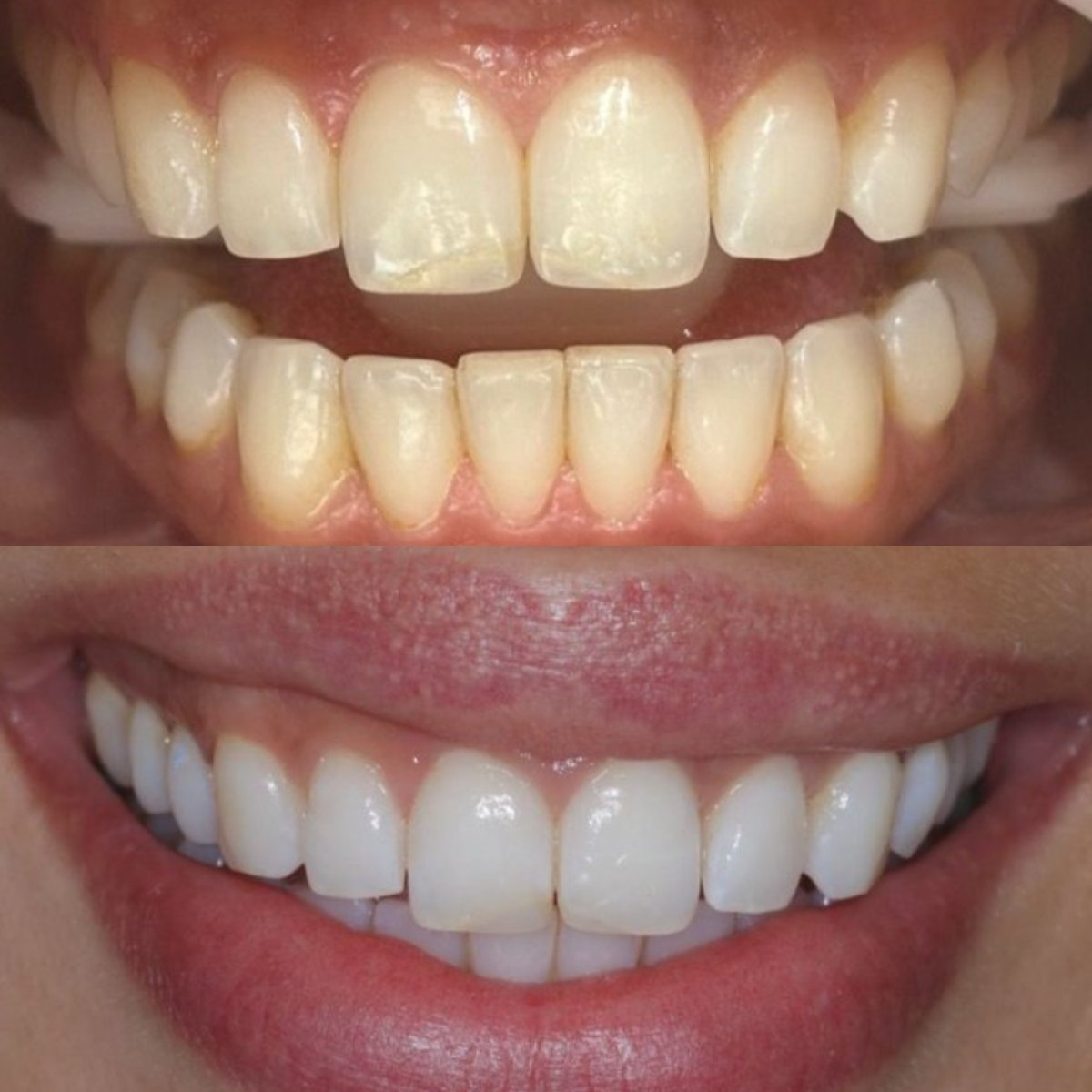 Resultados de blanqueamiento dental antes y después en Clínica Zago: sonrisa más blanca