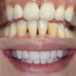 Composite Veneer results by Dr. - Patient’s before and after images Before and after Composite Veneer photos by Dr.