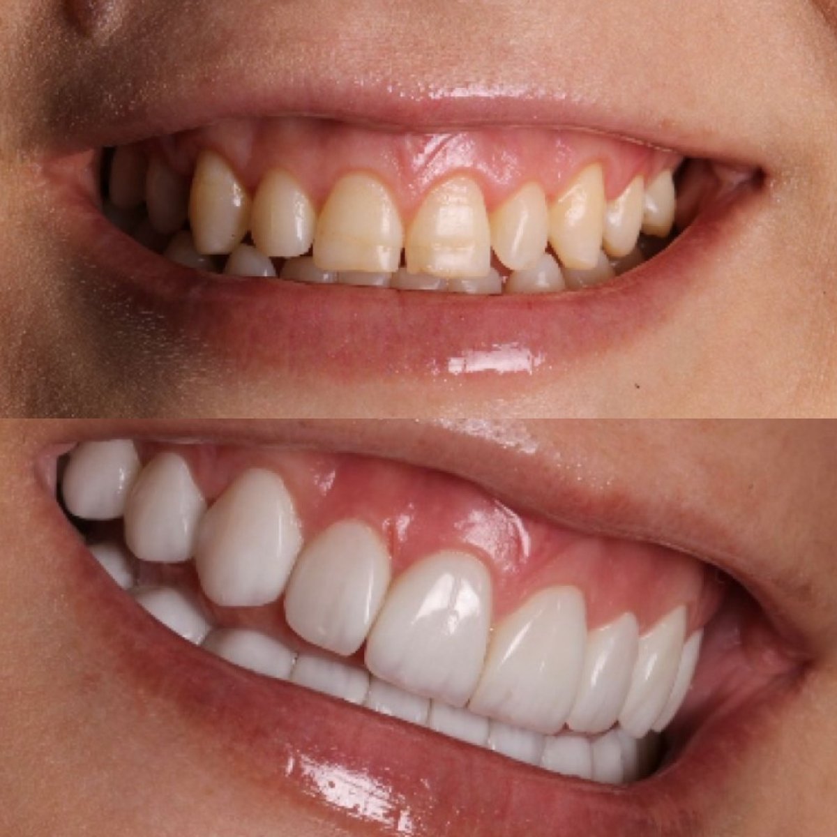 Before and after composite veneer results at Clínica Zago, improved smile aesthetics