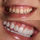Composite Veneer results by Dr. - Patient’s before and after images Before and after Composite Veneer photos by Dr.