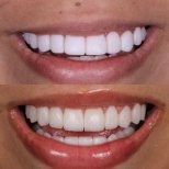 Composite Veneer results by Dr. - Patient’s before and after images Before and after Composite Veneer photos by Dr.