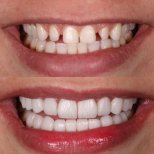 Composite Veneer results by Dr. - Patient’s before and after images Before and after Composite Veneer photos by Dr.