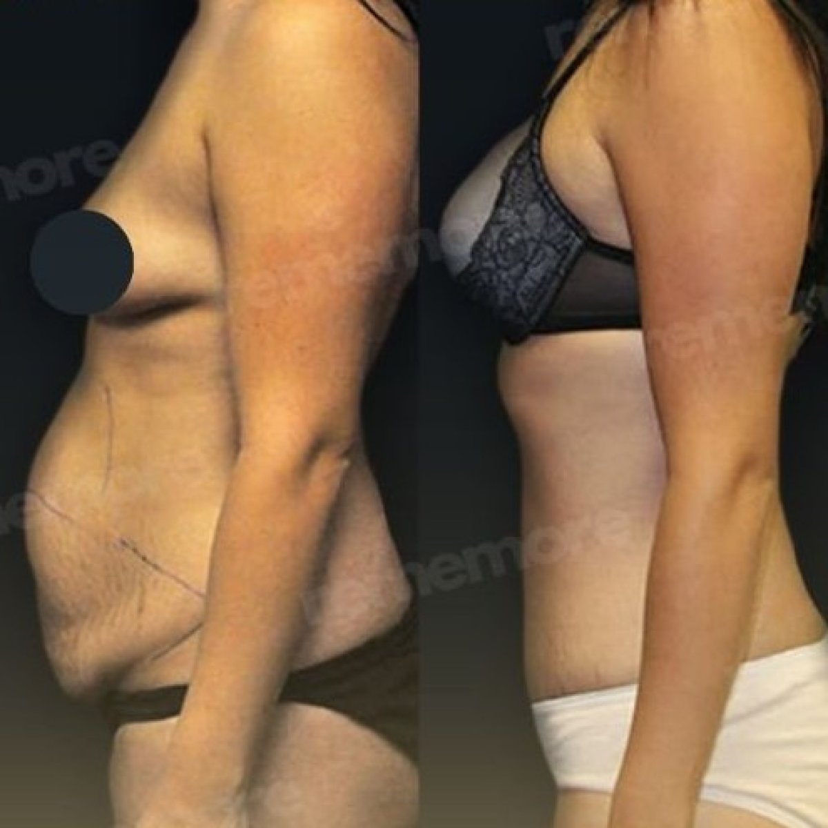 Before and after liposuction results at Memorial Göztepe Hospital, improved abdominal contour