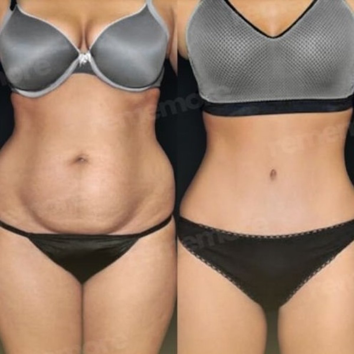 Résultats avant et après liposuccion à Memorial Göztepe Hospital, silhouette affinée visible