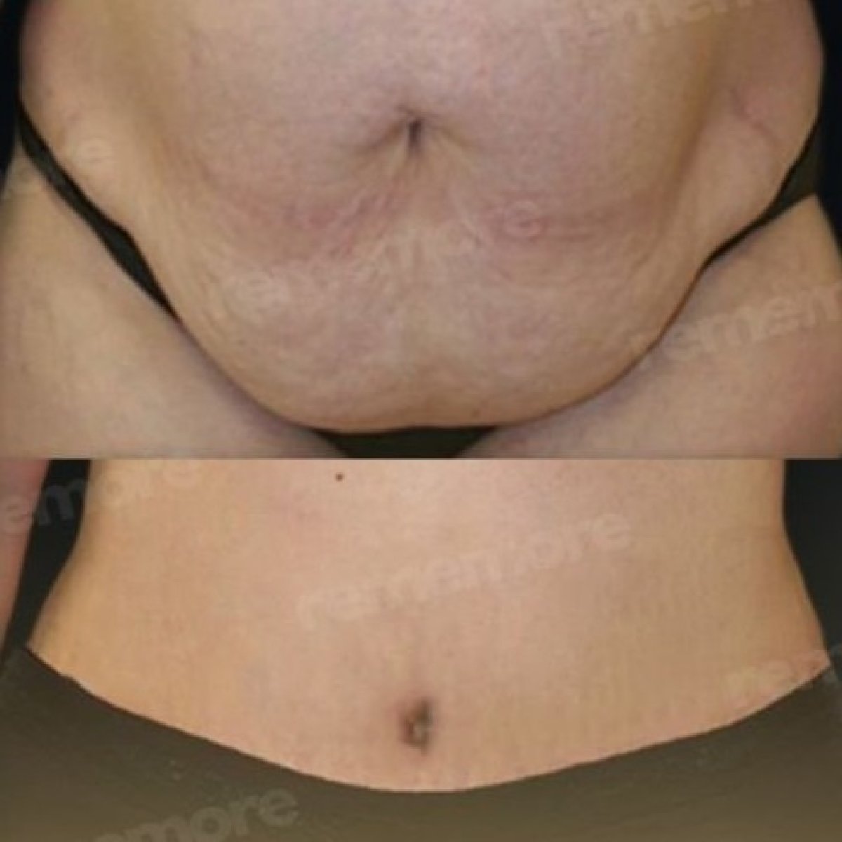 Before and after liposuction results at Memorial Göztepe Hospital, abdomen contour improvement