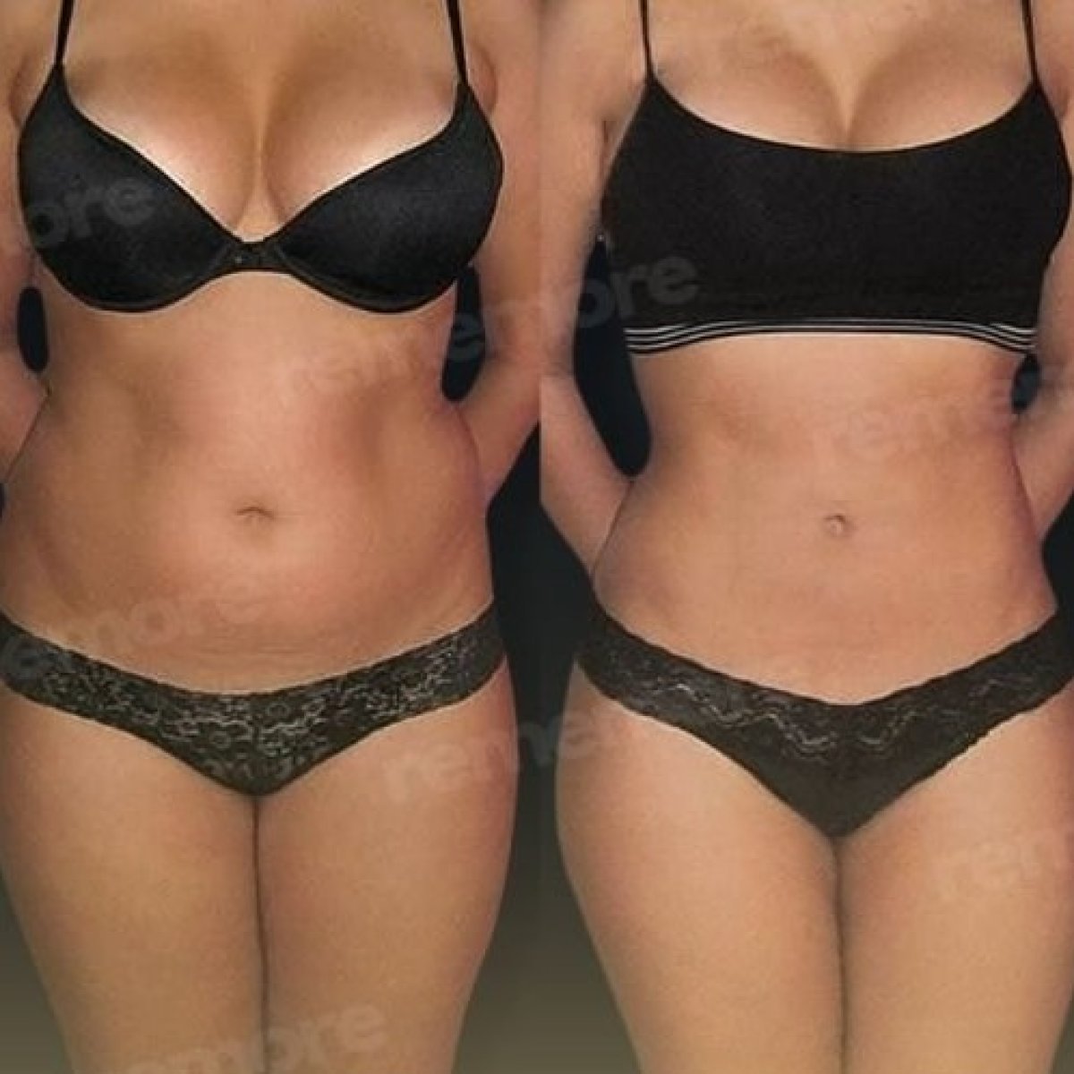 Resultados de liposucción 360 antes y después en Memorial Göztepe Hospital, mejora corporal