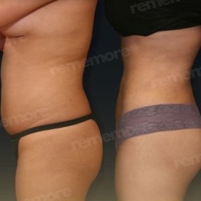 360 liposuction - photo 6