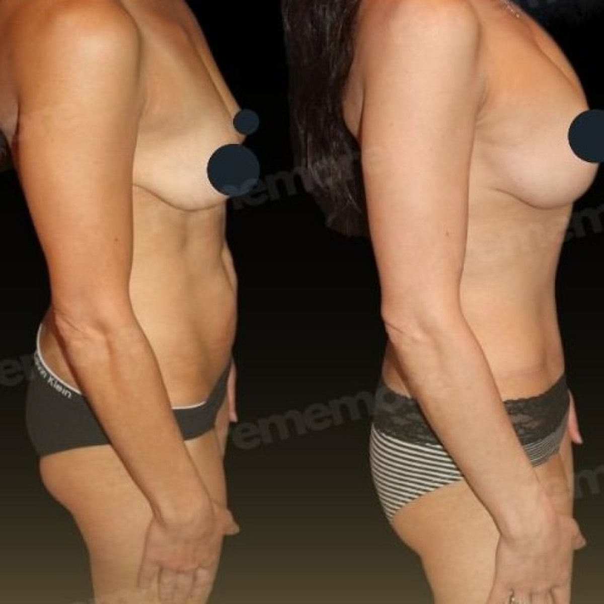 Before and after breast lift results at Memorial Ankara Hospital, improved breast contour