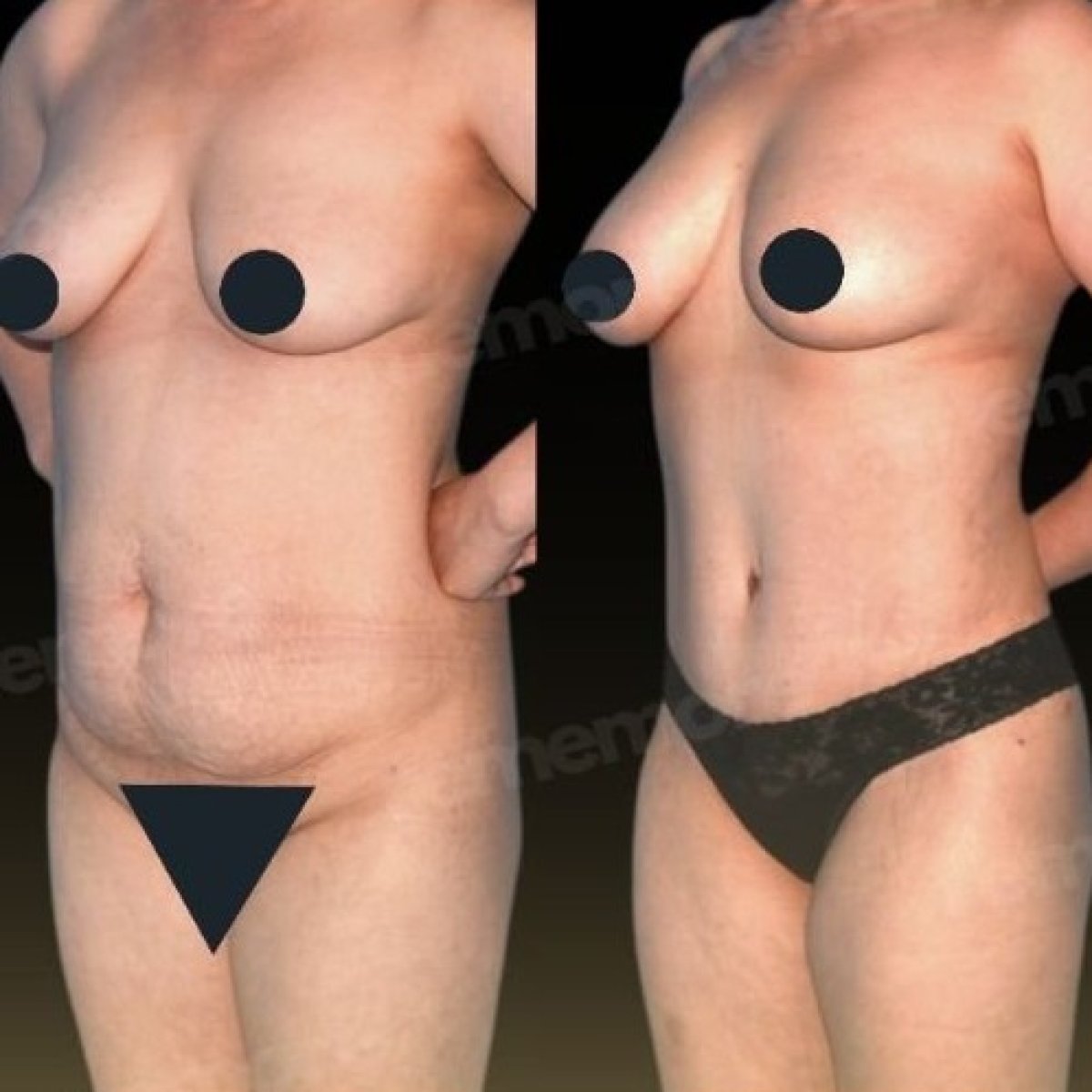 Before and after breast lift results at Memorial Ankara Hospital, improved breast contour