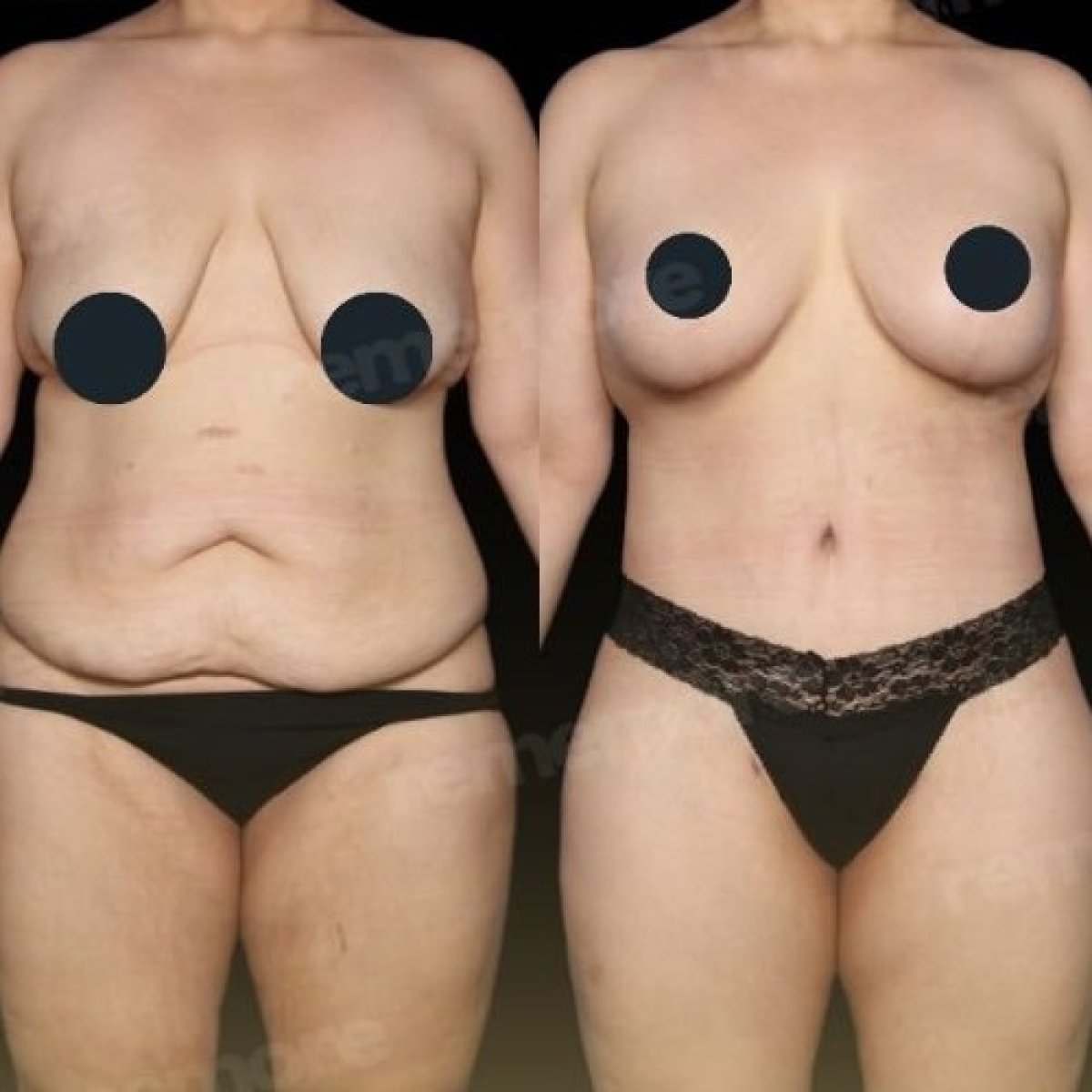 Before and after breast lift results at Memorial Ankara Hospital with improved breast shape