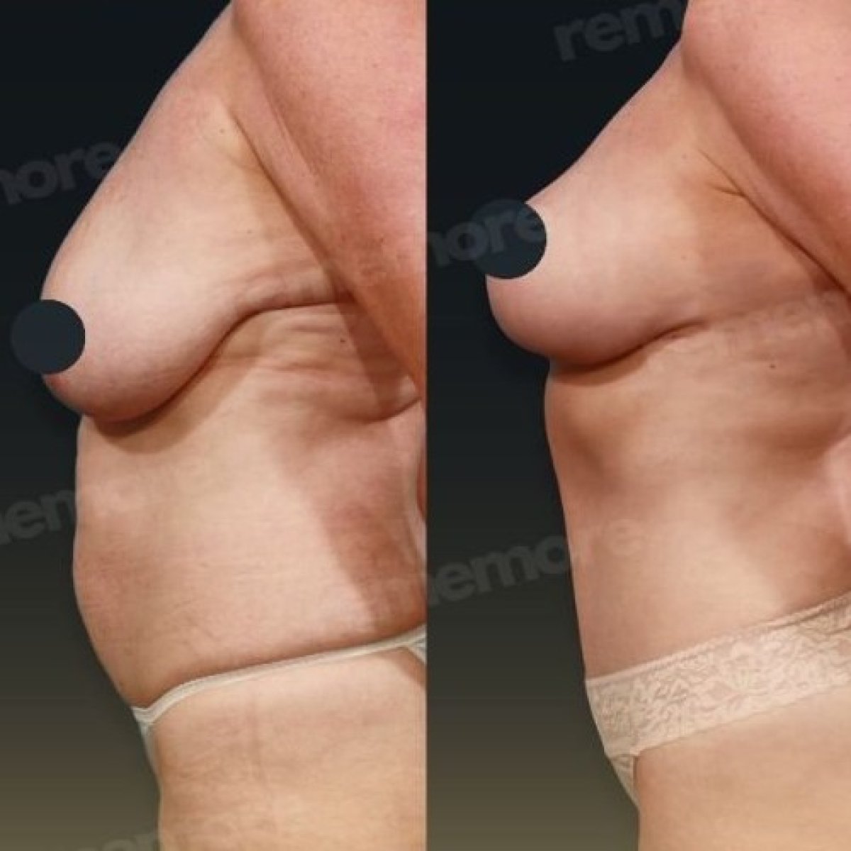 Before and after breast lift results at Memorial Ankara Hospital, improved breast contour