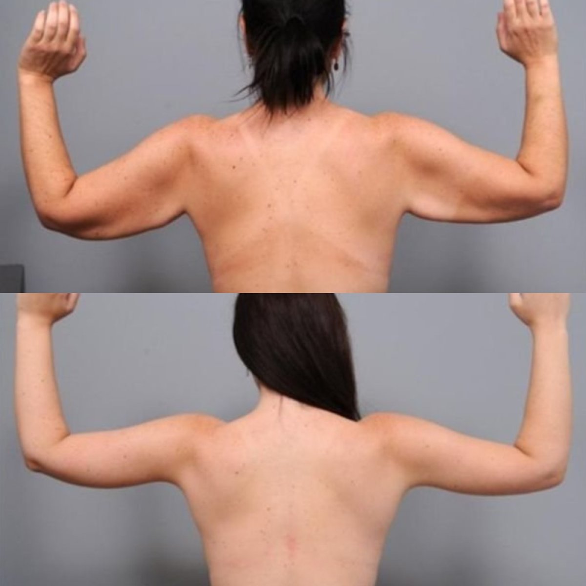 نتائج شد الذراعين قبل وبعد في Dr. Alexandro Aguilera - Plastic Surgery، تحسين الشكل