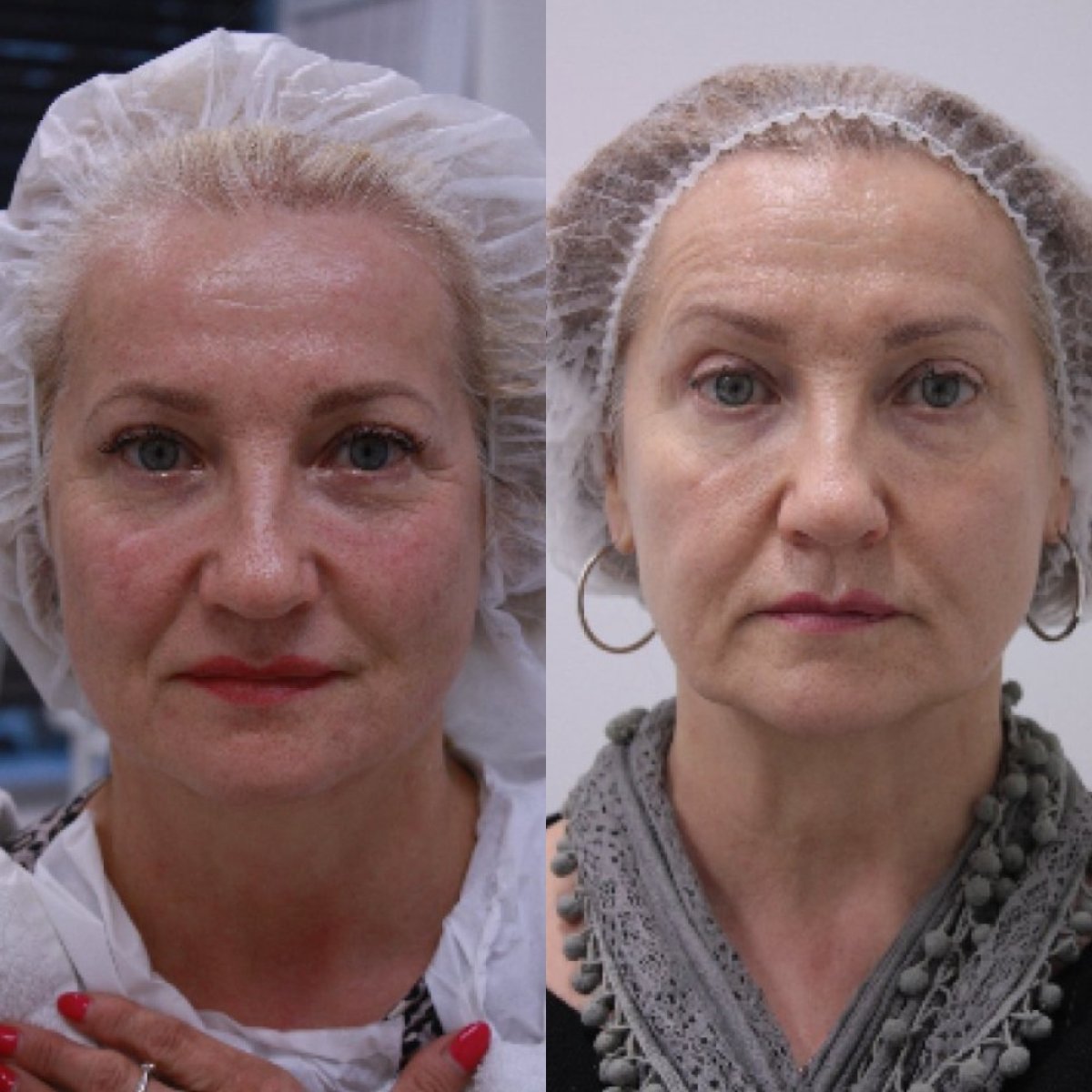 Resultados de lifting facial antes y después en Altos Clinic, rejuvenecimiento visible