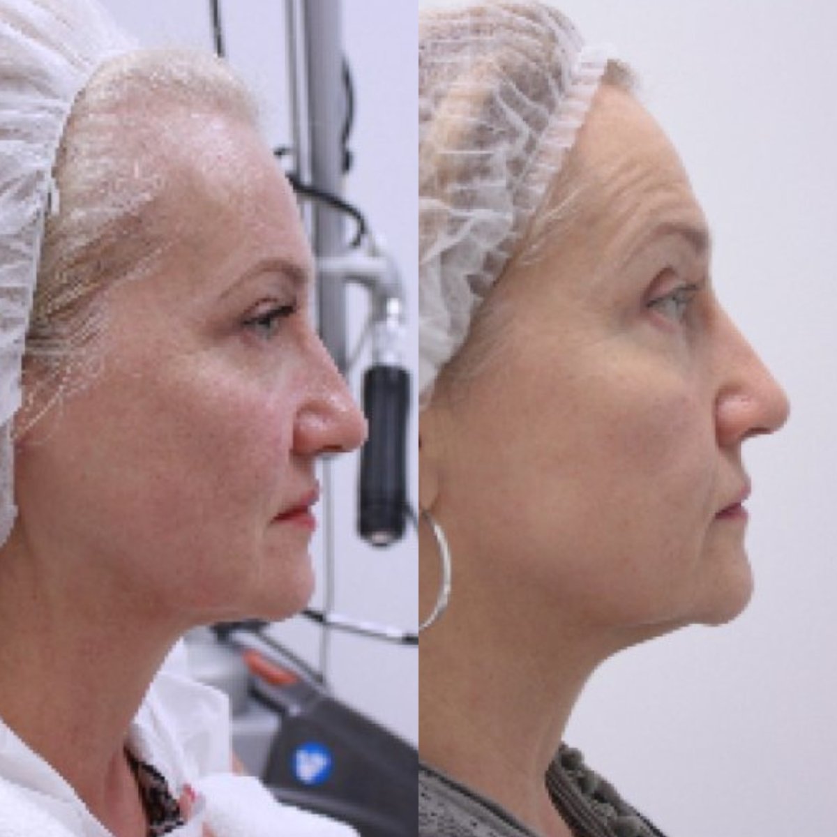 Resultados de lifting facial antes y después en Altos Clinic – mejora del contorno facial