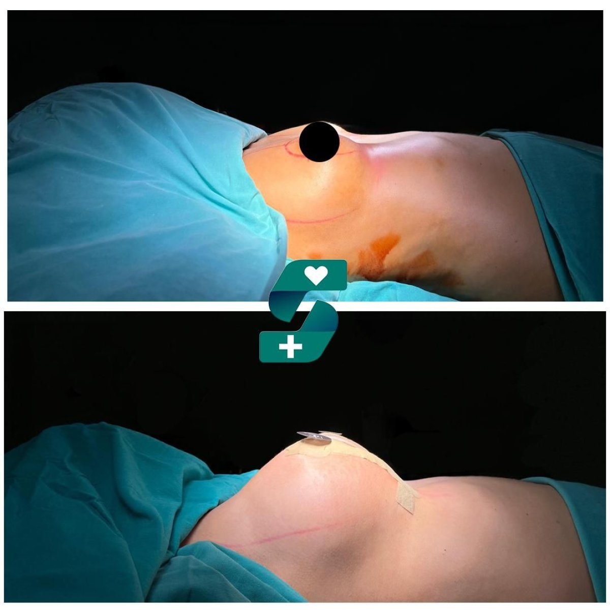 Before and after breast augmentation at Soraca Med – enhanced breast contour result