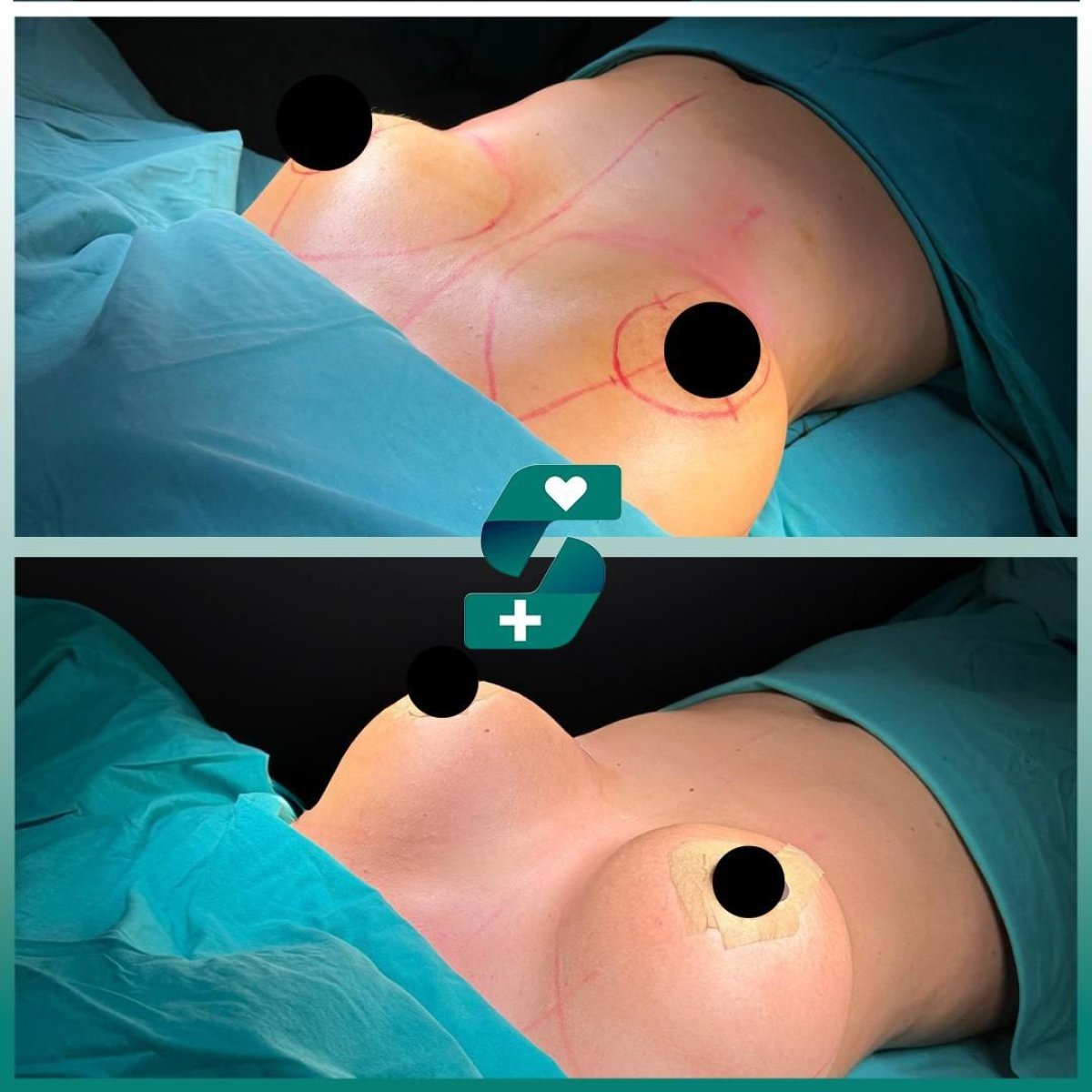 Before and after breast augmentation results at Soraca Med – enhanced breast shape and size