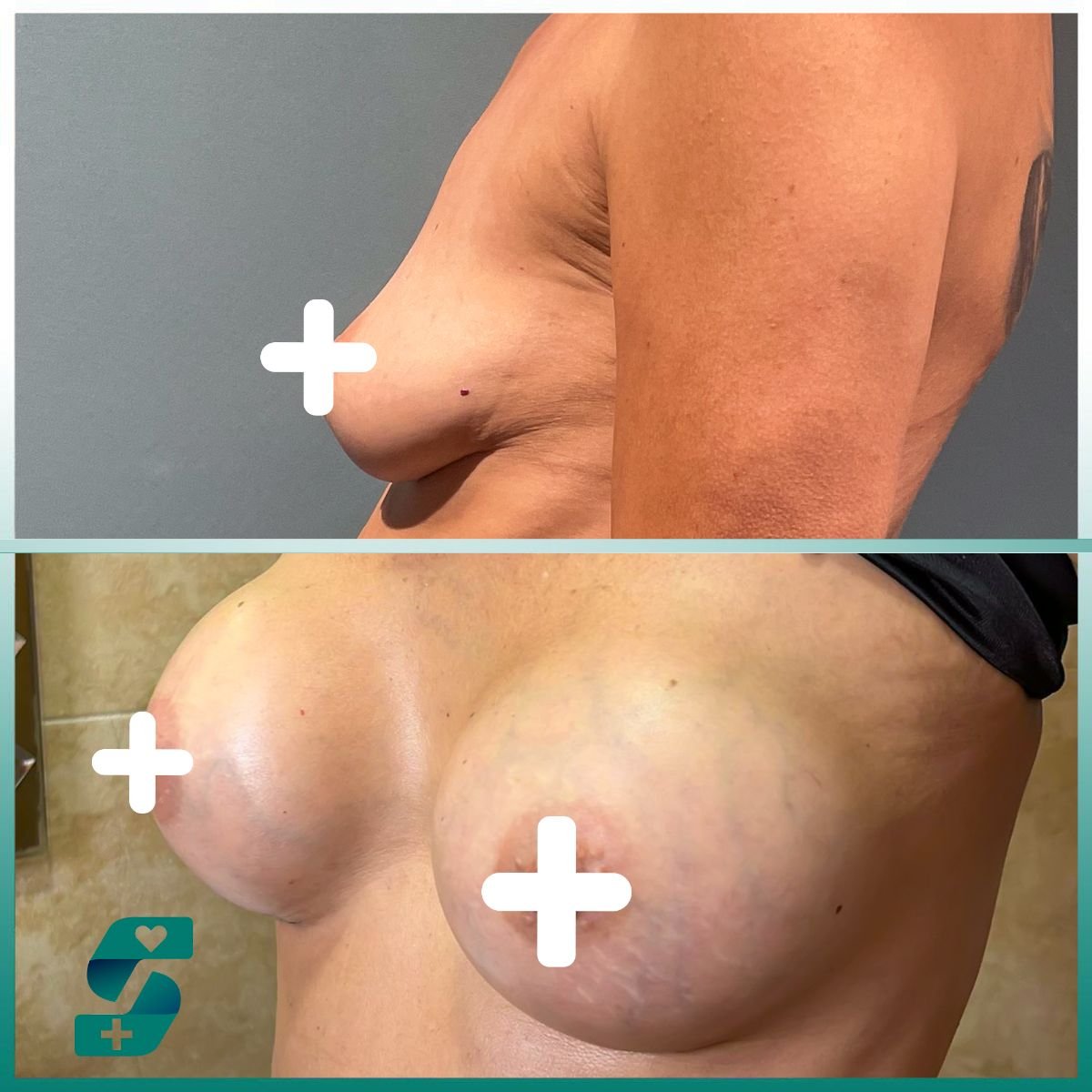 Before and after breast augmentation at Soraca Med, enhanced breast volume and contour result