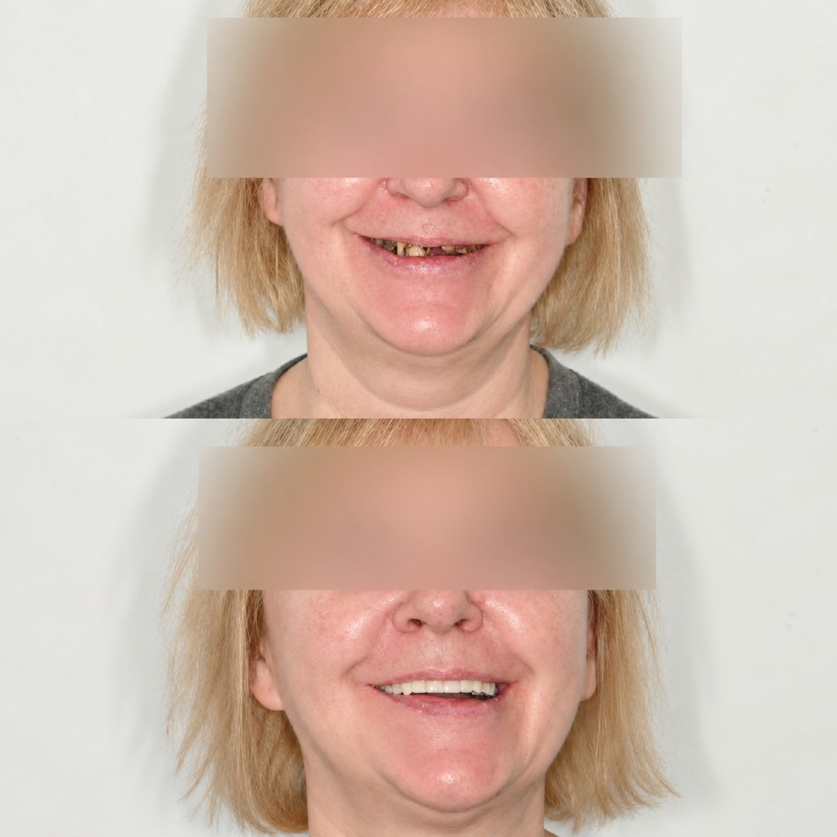 Before and after dental implant results at Unident Clinic – restored smile and missing teeth