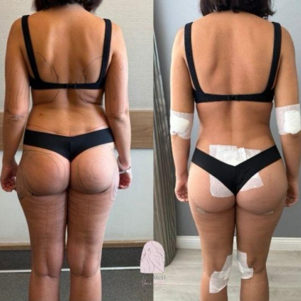 نتائج شفط الدهون قبل وبعد في Dr. MED – تحسين شكل الجسم وتقليل الدهون