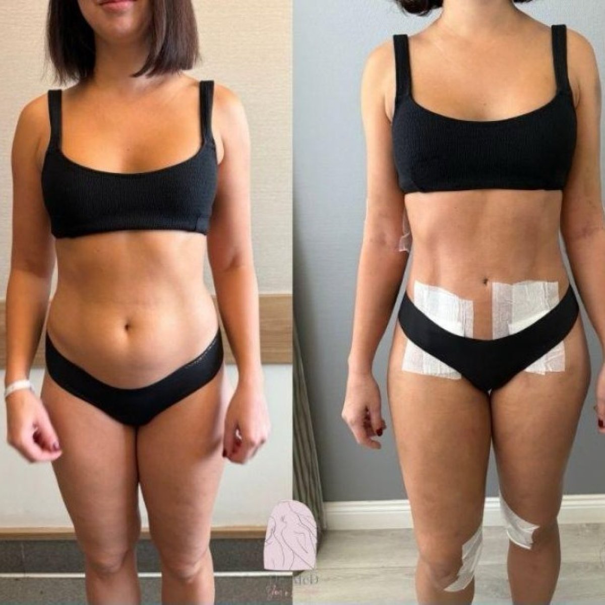 نتائج شفط الدهون قبل وبعد في Dr. MED – تحديد الجسم وخصر أنحف بشكل واضح