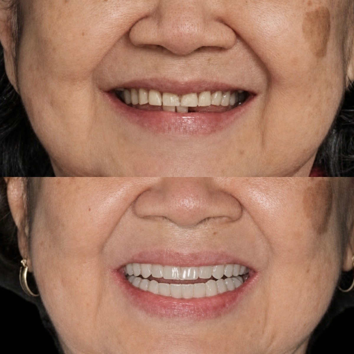 Resultados antes y después de implantes dentales All-on-6 en Clínica Zago, sonrisa mejorada